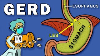 Gastroesophageal Reflux Disease GERD [upl. by Dode239]