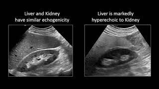 GI Imaging  Hepatic Steatosis and Cirrhosis [upl. by Eal466]