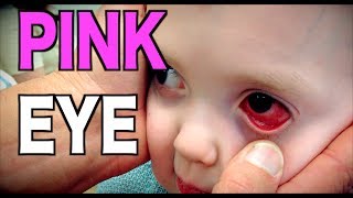 PINK EYE Live Diagnosis Conjunctivitis  Dr Paul [upl. by Trela89]