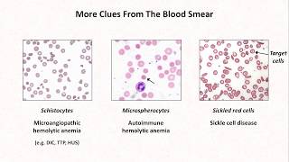 Anemia Lesson 4  Clues from the blood smear [upl. by Jarrow11]