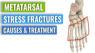 Metatarsal Stress Fractures  Causes Treatment Prevention [upl. by Ahsahtan]