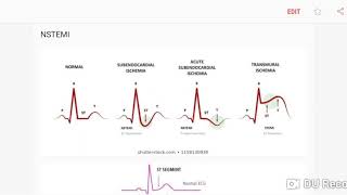 NSTEMI on ECG [upl. by Garrard163]