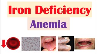 IronDeficiency Anemia Overview  Causes Pathophysiology Signs amp Symptoms Diagnosis Treatment [upl. by Asehr]