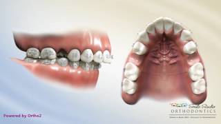 Upper 2nd Bicuspid Extraction  Overjet  Orthodontic Treatment [upl. by Hauser]