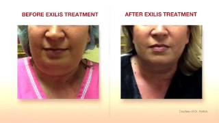 Exilis Elite Face Treatment Amara Clinic [upl. by Gans]