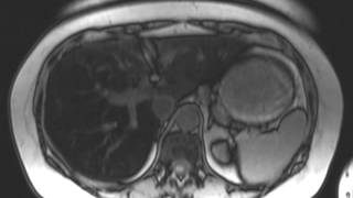 Hepatic Steatosis [upl. by Emolas]