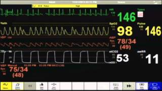 Cardiac Arrest  Patient Monitor [upl. by Yetac932]