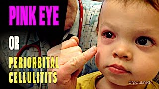 LIVE DIAGNOSIS Pink Eye or Periorbital Cellulitis  Dr Paul [upl. by Eesac435]