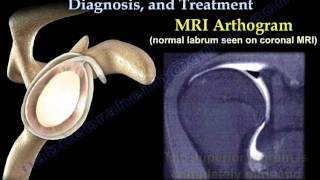 Hip Labrum Tear How to Assess amp Rehab at Home [upl. by Niltac]