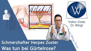 Herpes Zoster Gürtelrose durch WindpockenViren 😬 Schmerzen amp Ausschlag  Entstehung amp Therapie [upl. by Freddie]