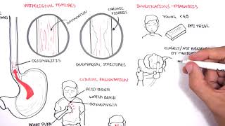 GORD GERD Gastro Oesophageal Reflux Disease  Overview pathophysiology treatment [upl. by Frankie522]