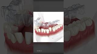 How Does Invisalign Aligners Work To Straighten Teeth [upl. by Ahsauqram]