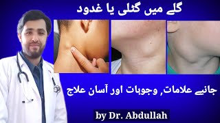 Swollen Lymph Nodes In Neck Symptoms Causes amp Treatment  Lymphadenopathy  Gale Ki Gilti Ya Ganth [upl. by Patti247]