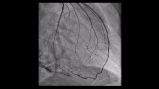 Constrictive Pericarditis [upl. by Ennaesor]