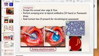 Bacterial Keratitis Part 2 [upl. by Coraline]