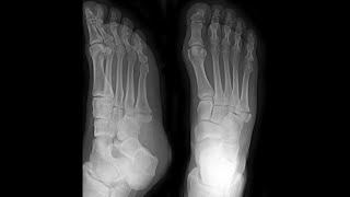 5th Metatarsal Base Fracture Foot [upl. by Jeanne]