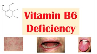 Vitamin B6 Pyridoxine Deficiency  Dietary Sources Causes Signs amp Symptoms Diagnosis Treatment [upl. by Acilejna]