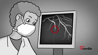 Treatment of Unstable Angina and Myocardial Infarction [upl. by Idnak]