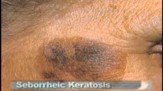 Common Skin Lesions [upl. by Kamin495]