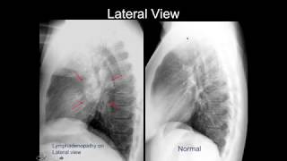 Chest Xray Cases 2 [upl. by Gabbie69]