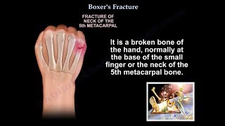 Boxers Fracture  Everything You Need To Know  Dr Nabil Ebraheim [upl. by Morville]