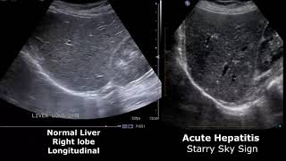 Liver Ultrasound Normal Vs Abnormal Image Appearances Comparison  Liver Ultrasound Pathologies [upl. by Alden]