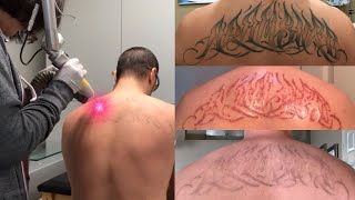 Laser Tattoo Removal  The Ugly Truth [upl. by Sardella]