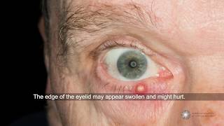 Are styes contagious and what can I do about them  Ask an Ophthalmologist [upl. by Agostino475]