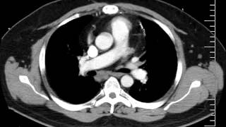 Mediastinal anatomy and nodal stations on CT [upl. by Anilahs]