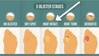 How To Treat A Blister Correctly First Look At Your Blister Roof [upl. by Odlanir]