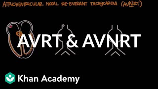 Atrioventricular reentrant tachycardia AVRT amp AV nodal reentrant tachycardia AVNRT [upl. by Enomas664]