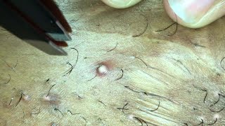 INFECTED INGROWN HAIR 05 [upl. by Anirdnaxela443]