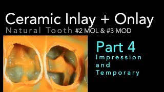 Lithium Disilicate Ceramics Part 4 Impression and Temporary [upl. by Surat]