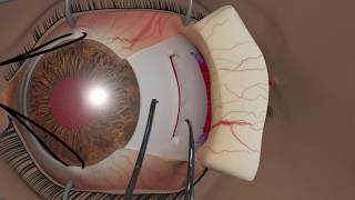 Strabismus surgery Recession [upl. by Llohcin940]