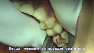 Painless and Easiest method for tooth extraction [upl. by Luehrmann]