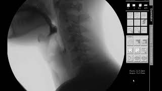 Mixed TexturePeaches  Modified Barium Swallow Study MBSS Lateral View HD [upl. by Eelyrag928]