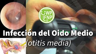 Infección del Oido Medio otitis media [upl. by Natsrik]