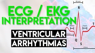 Ventricular Arrhythmias  ECG EKG Interpretation Part 5 [upl. by Lancelle]